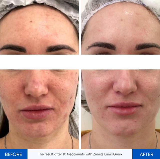 Zemits LumaGenix PDT プロフェッショナルLED光治療デバイス