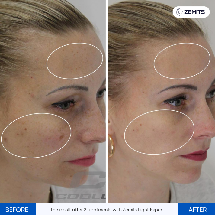 Zemits Light Expert 2.0 IPLレーザー機械