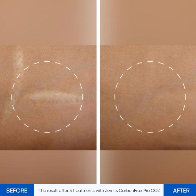 Zemits CarbonFrax Pro: CO2フラクショナルレーザー