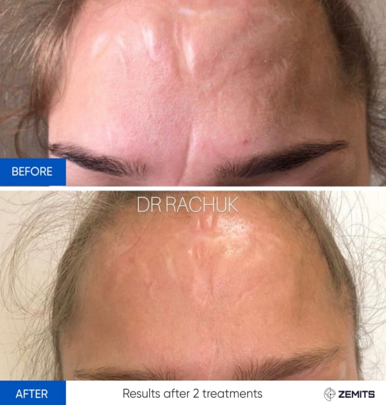 Zemits CarbonFrax Pro: CO2フラクショナルレーザー