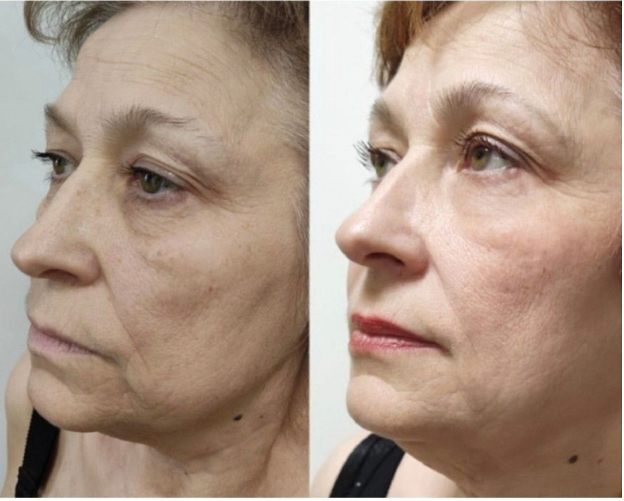 Zemits LumaGenix PDT プロフェッショナルLED光治療デバイス