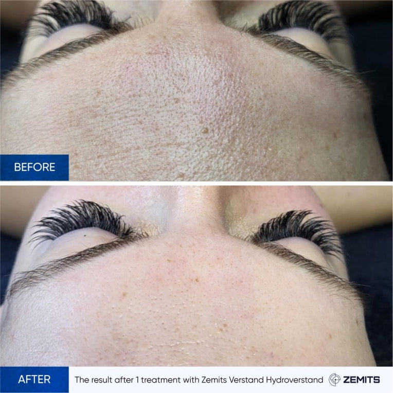 Zemits HydroVerstand PRO 7-in-1 ハイドロダイヤモンド™システム