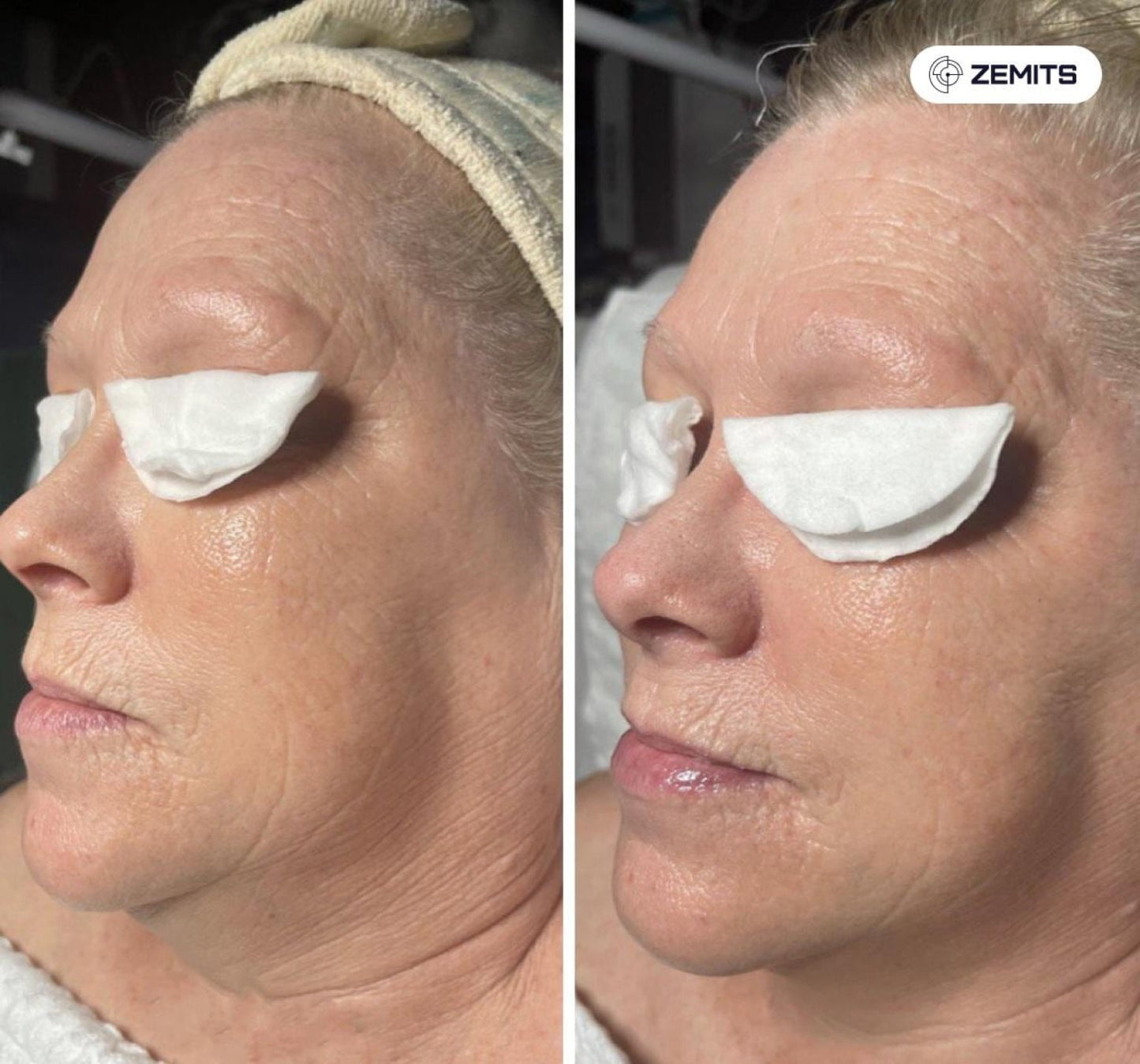 Zemits Klein EL エレクトロポレーションシステム