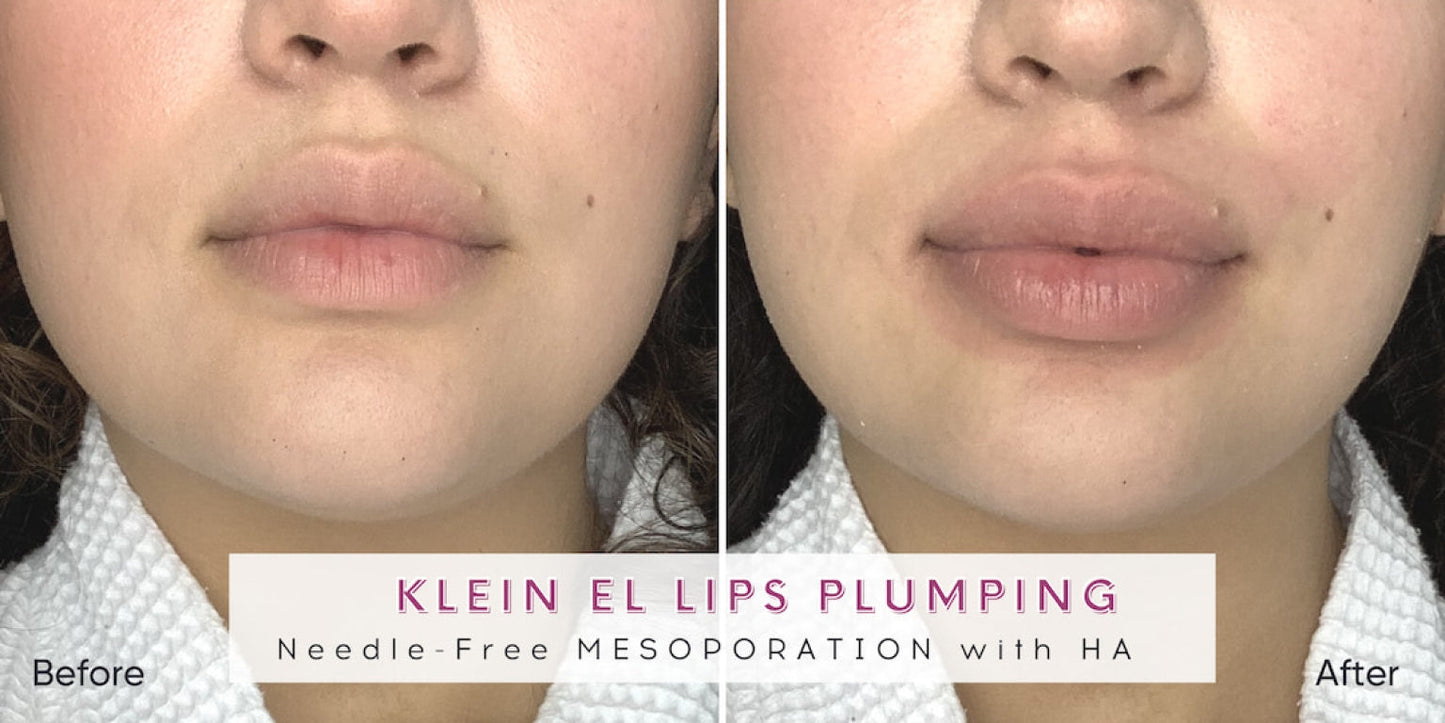 Zemits Klein EL エレクトロポレーションシステム