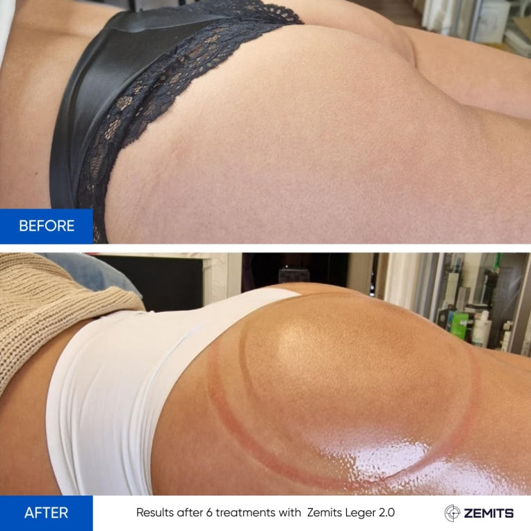 Zemits Leger 2.0 真空カッピングシステム XXLカップセット付き