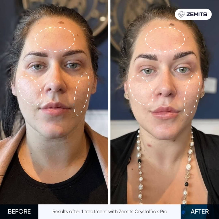 Zemits CrystalFrax PRO 非侵襲的フラクショナルRFシステム