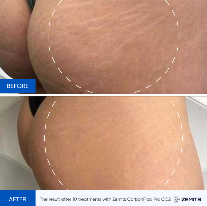 Zemits CarbonFrax Pro: CO2フラクショナルレーザー