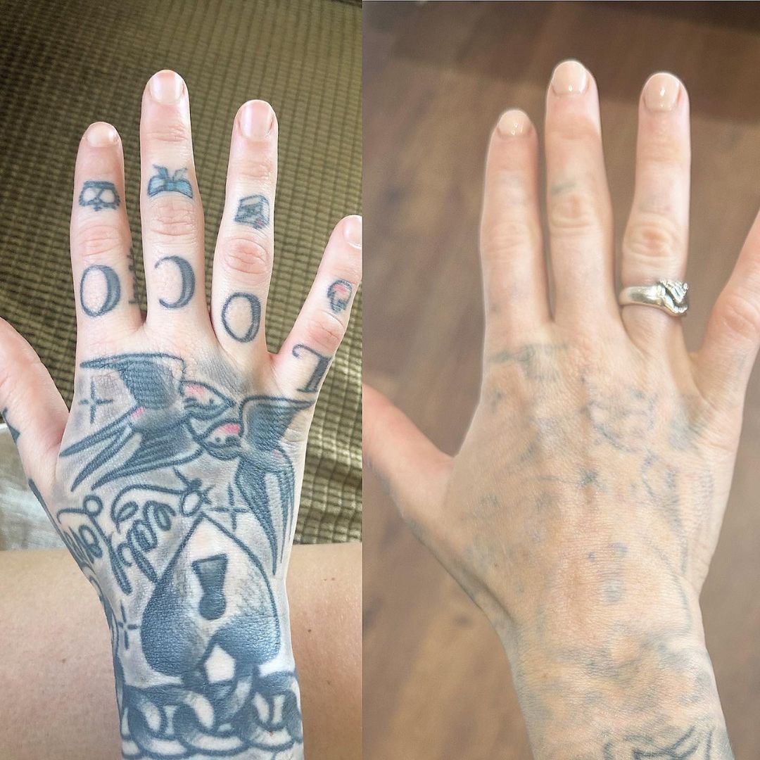 Zemits YAGenix QスイッチNd:YAGレーザー