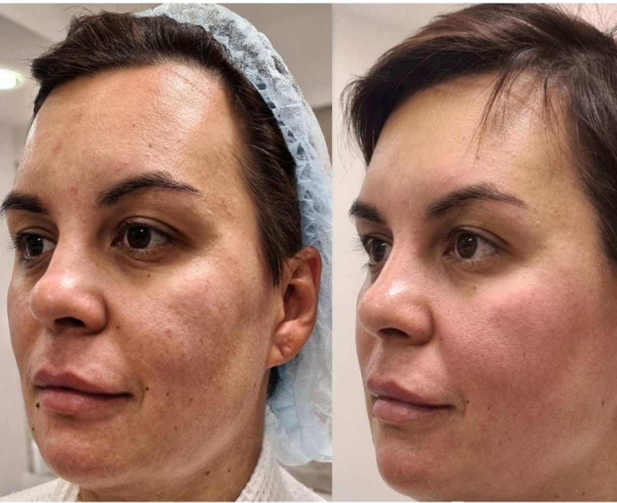 Zemits LumaGenix PDT プロフェッショナルLED光治療デバイス