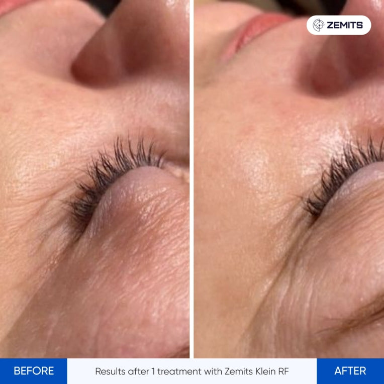 Zemits Klein RF 皮膚引き締めシステム