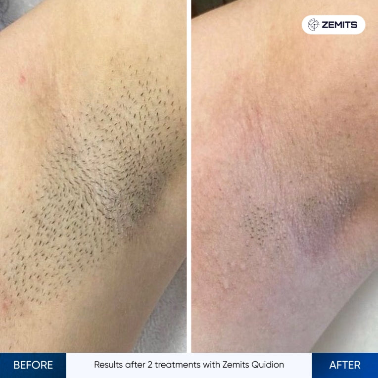 Zemits Quidion ダイオードレーザー脱毛用