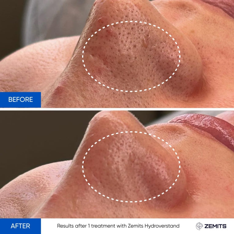 Zemits HydroVerstand PRO 7-in-1 ハイドロダイヤモンド™システム