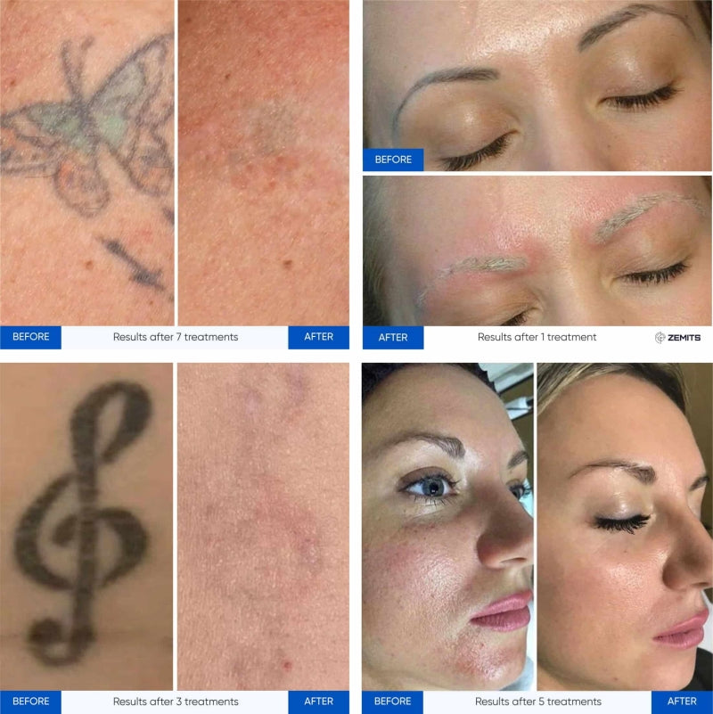 Zemits YAGenix QスイッチNd:YAGレーザー